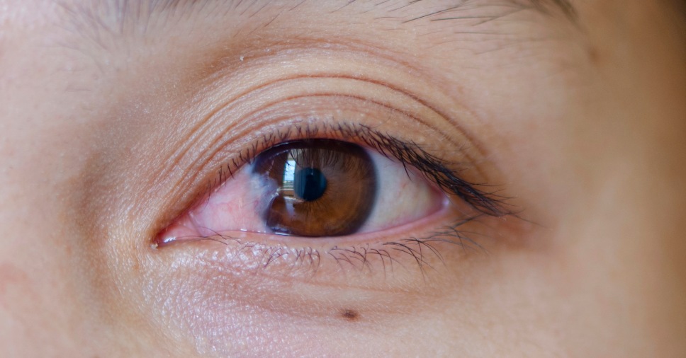 Close em olho com tecido membranoso sobre a córnea ilustra o pterígio fibrovascular.