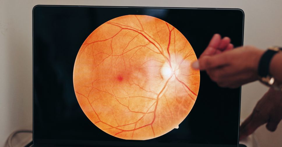 Exame retiniano para diagnóstico oftalmológico e explicação sobre o que é buraco macular